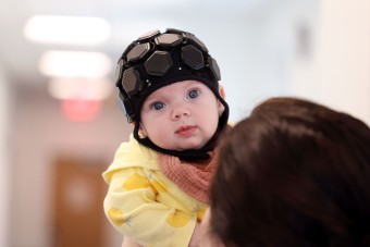 pic of baby wearing brain helmet